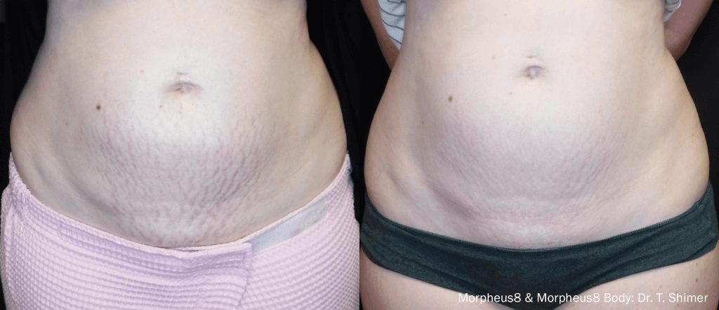 Morpheus8 Skin Tightening Treatment